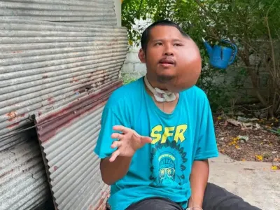 泰国31岁男子脸部长巨大肿块，被网友质疑AI造假