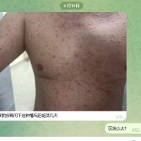 西港找了个按摩妹，没戴套，现在身上开始长痘了……