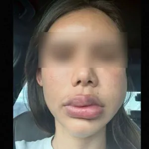 芭提雅医美事故曝光 注射填充物致女子长期面部肿胀
