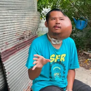 泰国31岁男子脸部长巨大肿块，被网友质疑AI造假